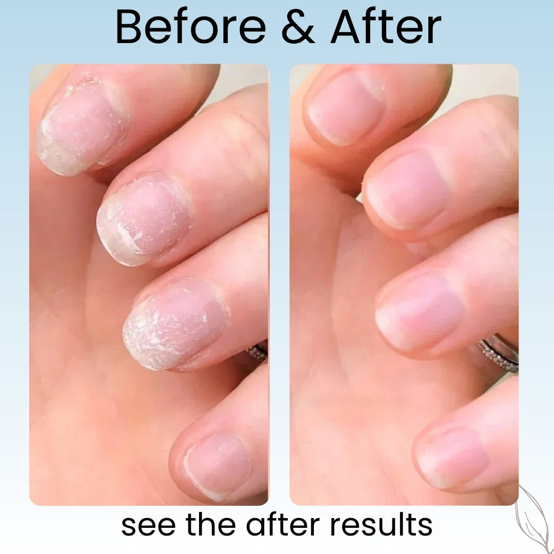 Svarna™- Nail Growth Pen