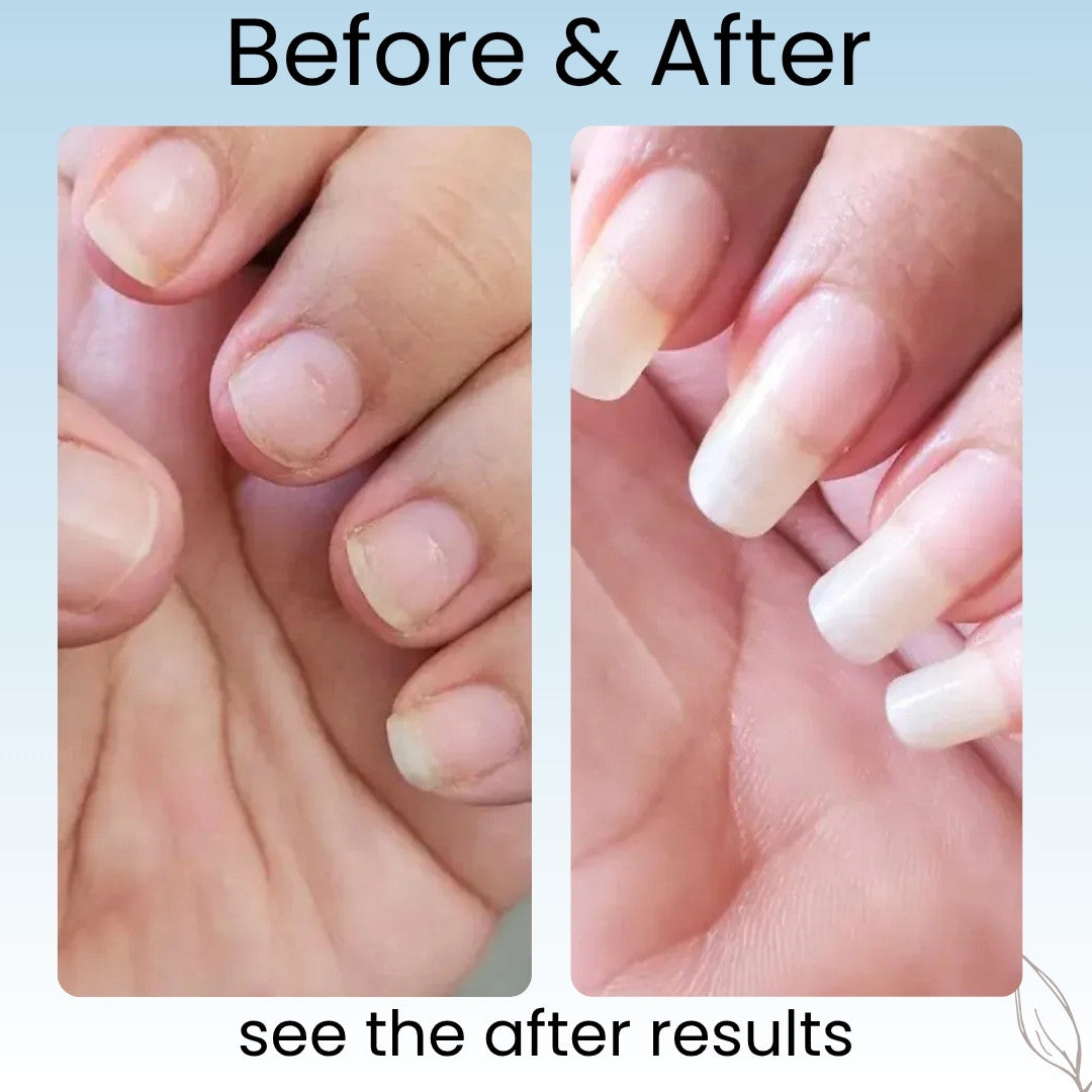 Svarna™- Nail Growth Pen